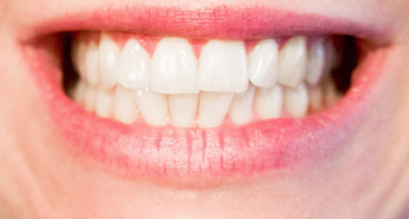 Invento que garantiu a 31ª carta patente da UFC pode ser aplicado em pacientes com deficiência de minerais nos dentes. Foto: PxHere.